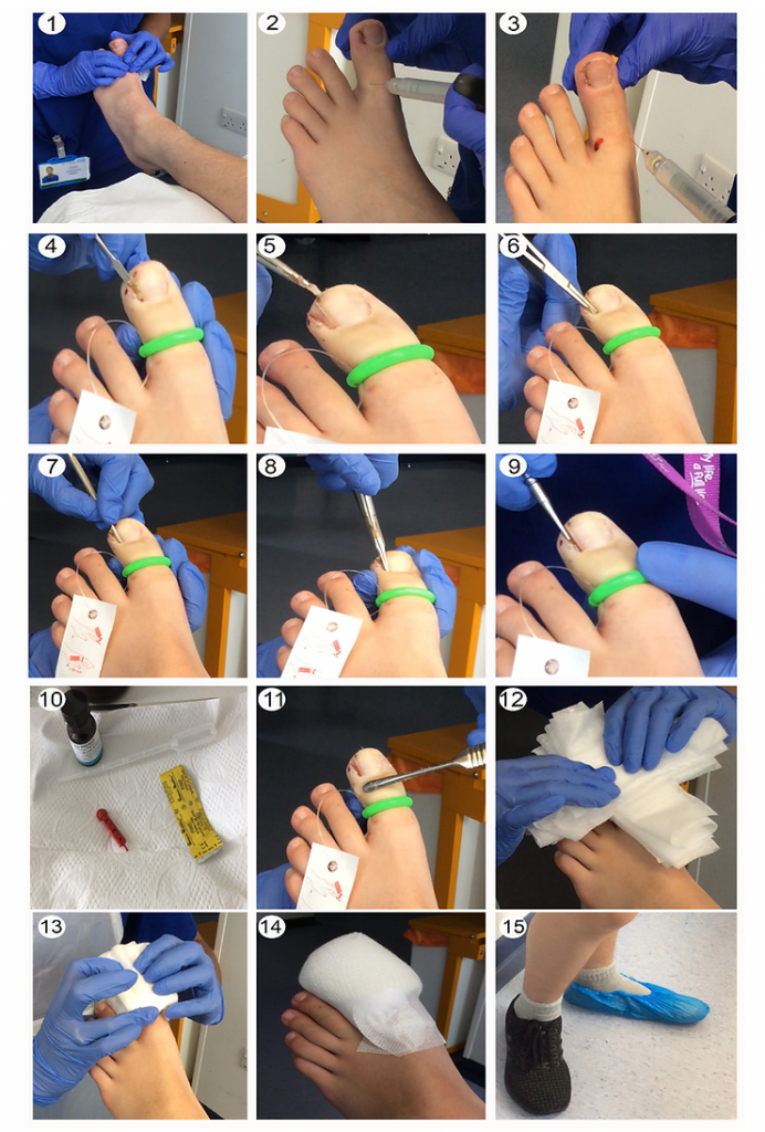 nail surgery steps